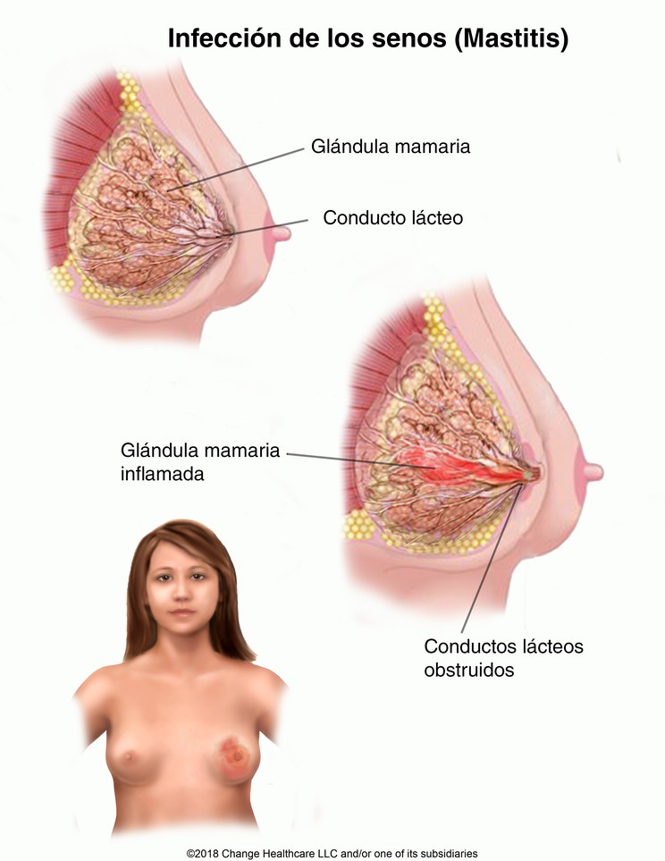 Breast Infection (Mastitis): Illustration