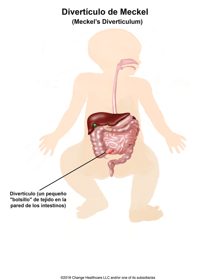 Meckel's Diverticulum: Illustration