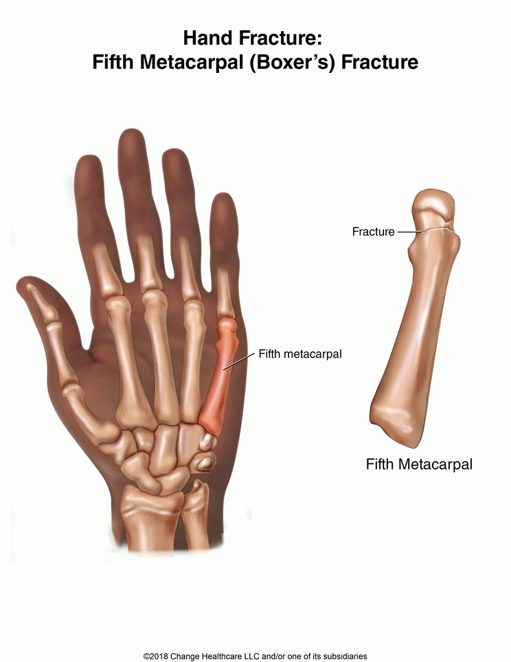 Hand Fracture: Fifth Metacarpal (Boxer's) Fracture, Illustration