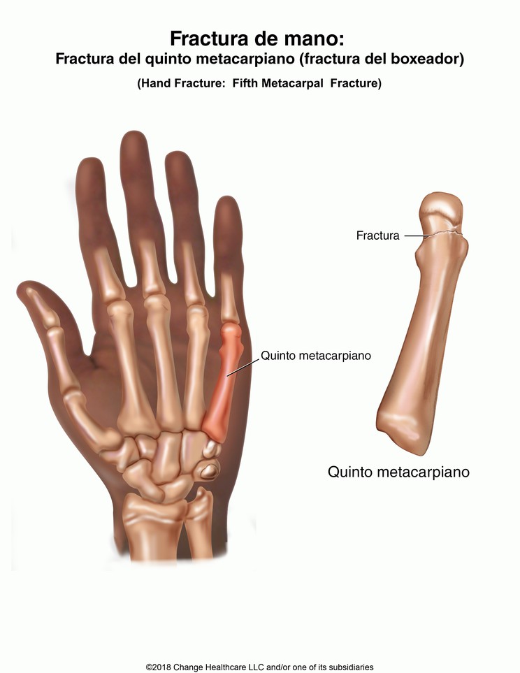 Hand Fracture: Fifth Metacarpal (Boxer's) Fracture, Illustration