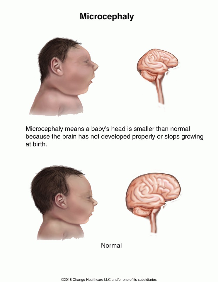 Microcephaly: Illustration