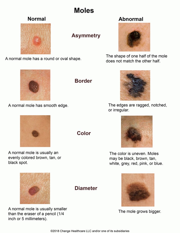 Moles (ABCD): Illustration