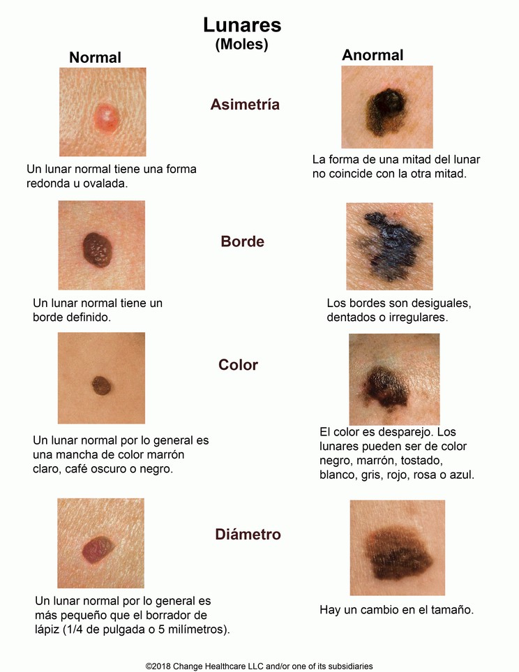 Moles (ABCD): Illustration