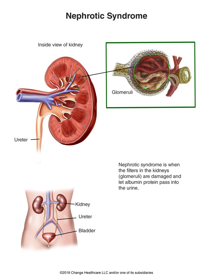 Nephrotic Syndrome: Illustration