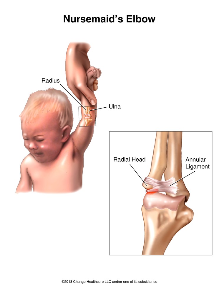 Nursemaid's Elbow: Illustration