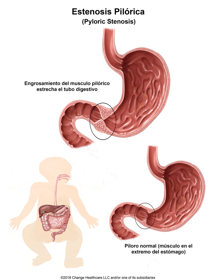 Pyloric Stenosis: Illustration