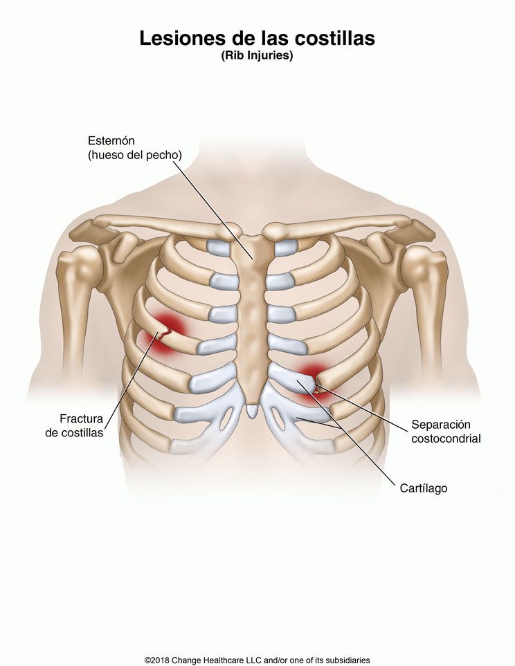 Rib Injuries: Illustration