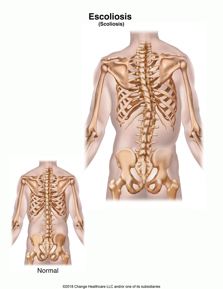 Scoliosis: Illustration