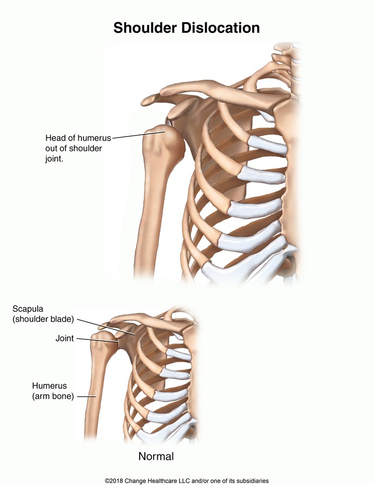 Shoulder Dislocation: Illustration