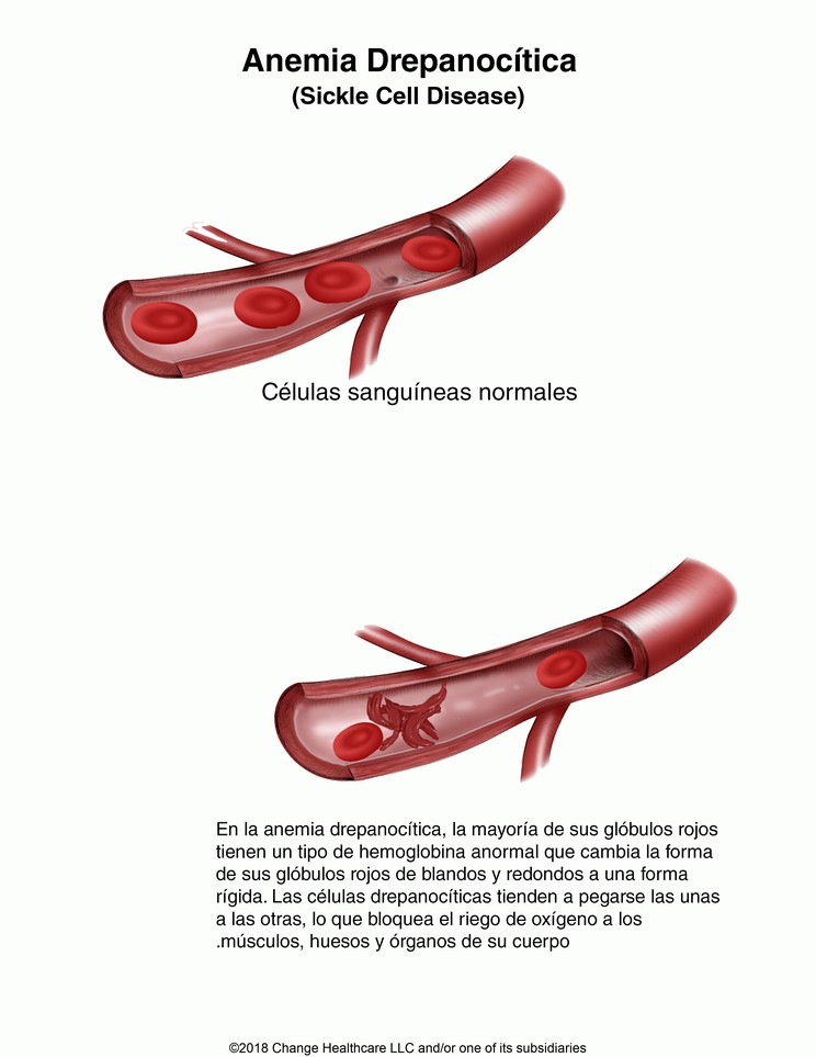 Sickle Cell Anemia: Illustration