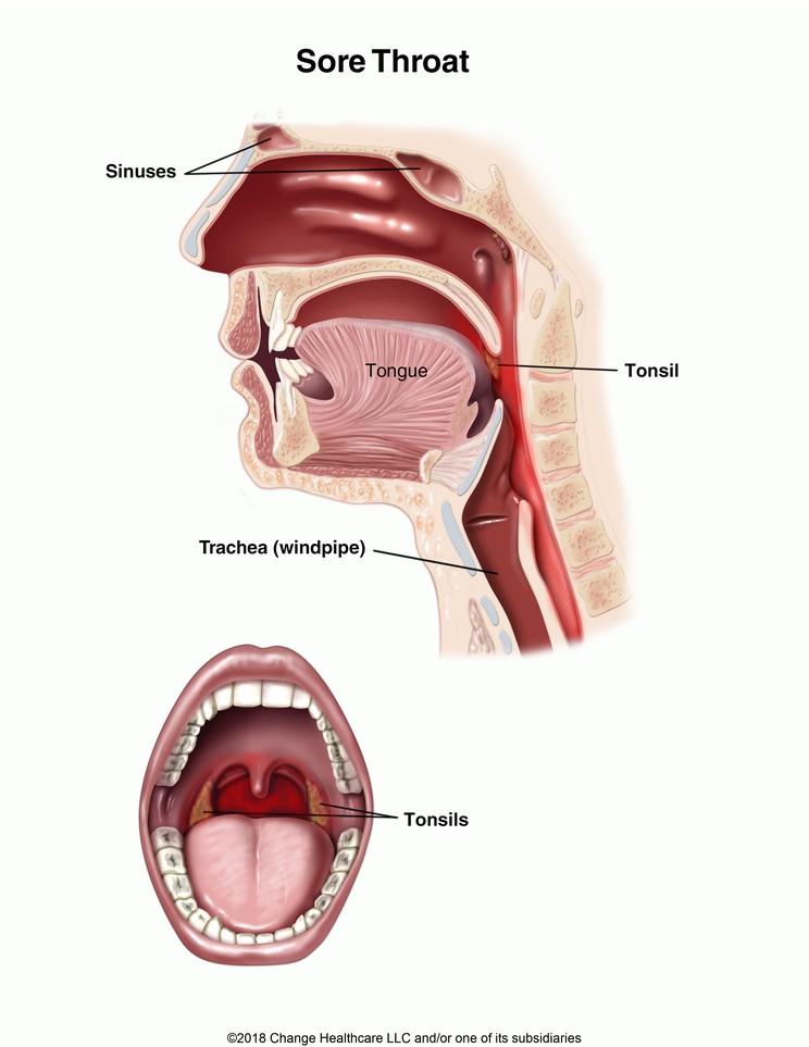 Sore Throat: Illustration