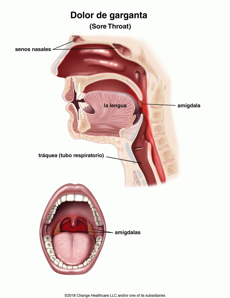 Sore Throat: Illustration