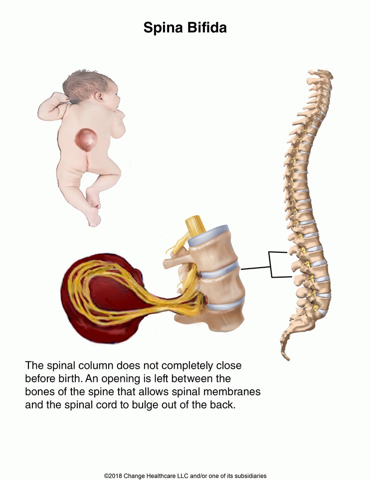 Spina Bifida: Illustration