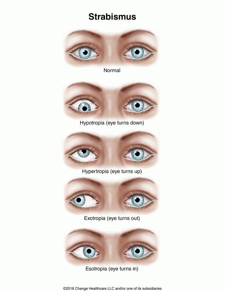 Strabismus: Illustration