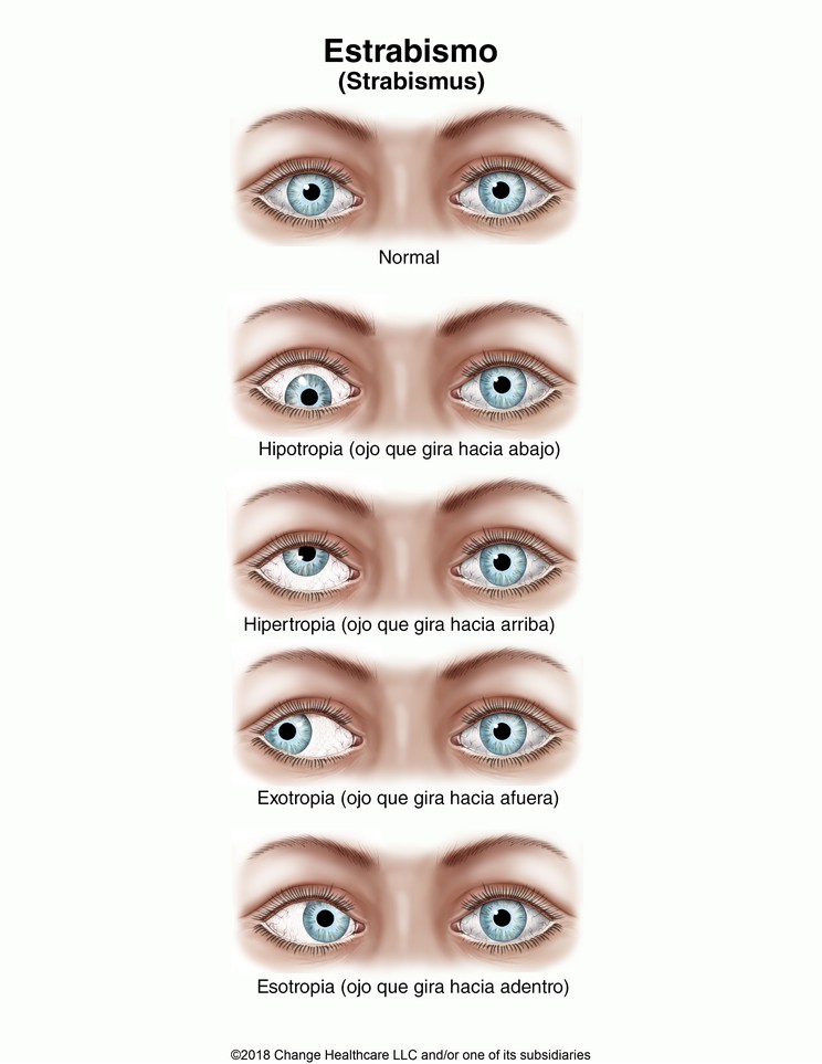 Strabismus: Illustration