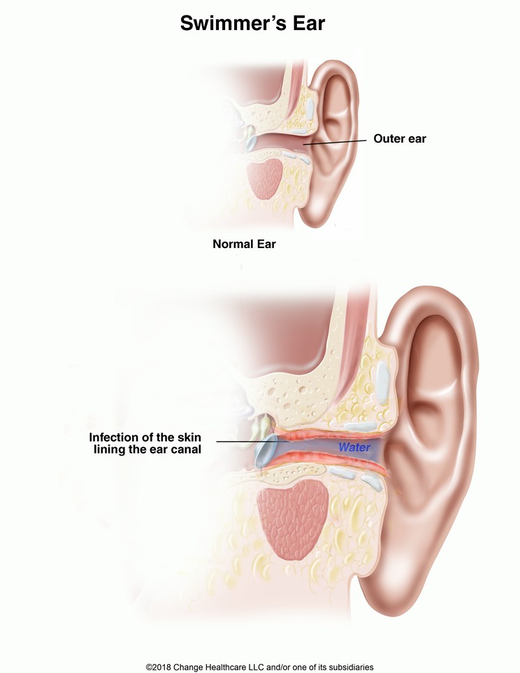 Swimmer's Ear: Illustration