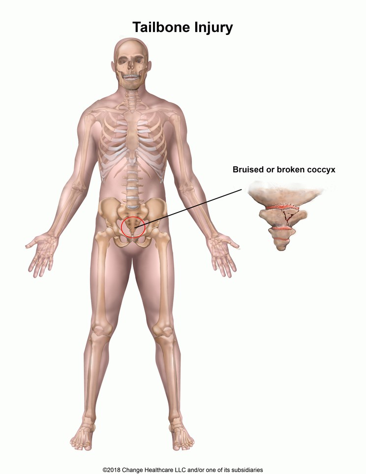 Tailbone Injury: Illustration