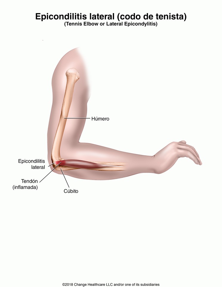 Tennis Elbow: Illustration