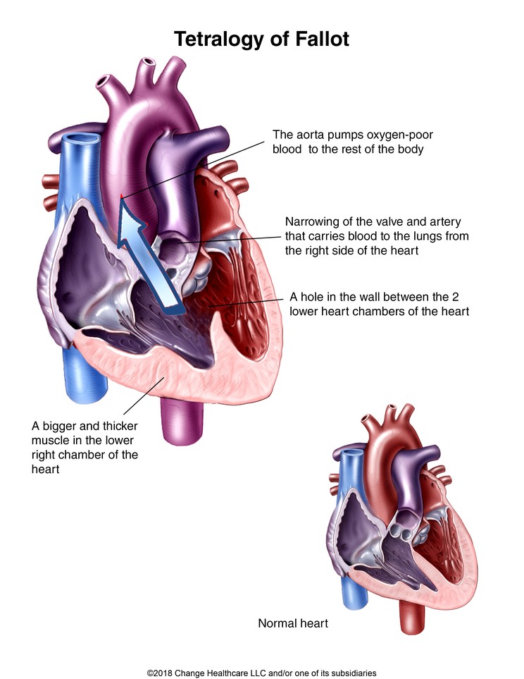 Tetralogy of Fallot: Illustration