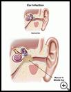 Thumbnail image of: Ear Infection (Otitis Media): Illustration