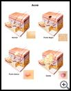 Thumbnail image of: Acne: Illustration