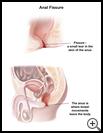Thumbnail image of: Anal Fissure: Illustration