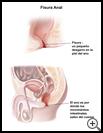 Thumbnail image of: Anal Fissure: Illustration