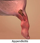 Thumbnail image of: Appendicitis (pediatric): Animation