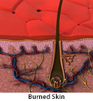 Thumbnail image of: Burned Skin: Animation