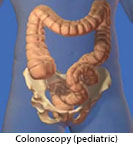 Thumbnail image of: Colonoscopy (pediatric): Animation