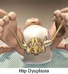 Thumbnail image of: Developmental Dysplasia of the Hip (pediatric): Animation