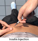 Thumbnail image of: Diabetes: How to Give an Insulin Injection: Animation