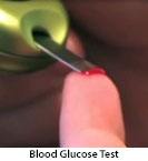 Thumbnail image of: Diabetes: How to Test Blood Glucose: Animation