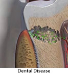 Thumbnail image of: Dental Disease: Animation