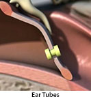 Thumbnail image of: Ear Infection and Tubes (pediatric): Animation