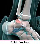 Thumbnail image of: Ankle Fracture (pediatric): Animation