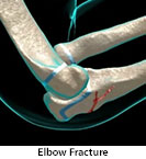 Thumbnail image of: Elbow Fracture (Olecranon Fracture) (pediatric): Animation
