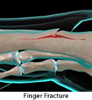 Thumbnail image of: Finger Fracture (pediatric): Animation