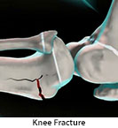 Thumbnail image of: Knee Fracture (pediatric): Animation