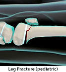 Thumbnail image of: Leg Fracture (pediatric): Animation