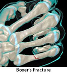 Thumbnail image of: Fifth Metacarpal Fracture (Boxer’s Fracture) (pediatric): Animation