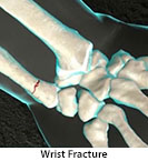 Thumbnail image of: Wrist Fracture (pediatric): Animation
