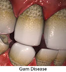 Thumbnail image of: Gum Disease: Animation