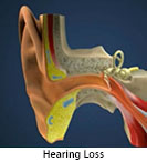 Thumbnail image of: Hearing Loss: Animation