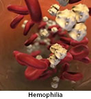 Thumbnail image of: Hemophilia: Animation