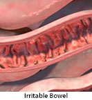 Thumbnail image of: Irritable Bowel Syndrome (IBS): Animation