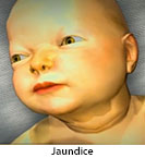 Thumbnail image of: Jaundice (pediatric): Animation