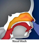 Thumbnail image of: Nasal Saline Irrigations (pediatric): Animation