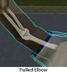 Thumbnail image of: Nursemaid’s Elbow (Pulled Elbow) (pediatric): Animation