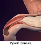 Thumbnail image of: Pyloric Stenosis (pediatric): Animation